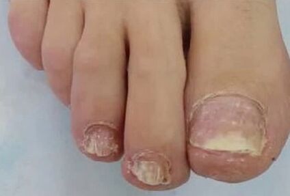The nails were seriously affected by the fungus