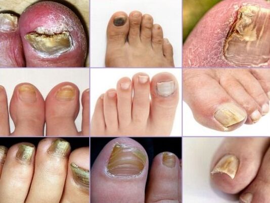 Damage to nails on different types of fungi