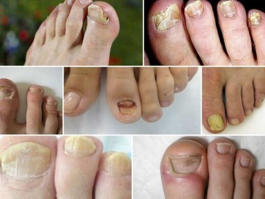 Different forms of nails