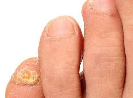 Fungi on your feet