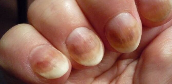Infection with mycosis nails