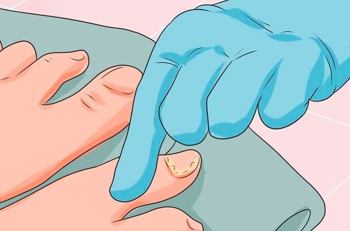 The first signs of mycosis nails