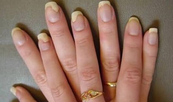 This looks like a nail fungus in the worsening phase