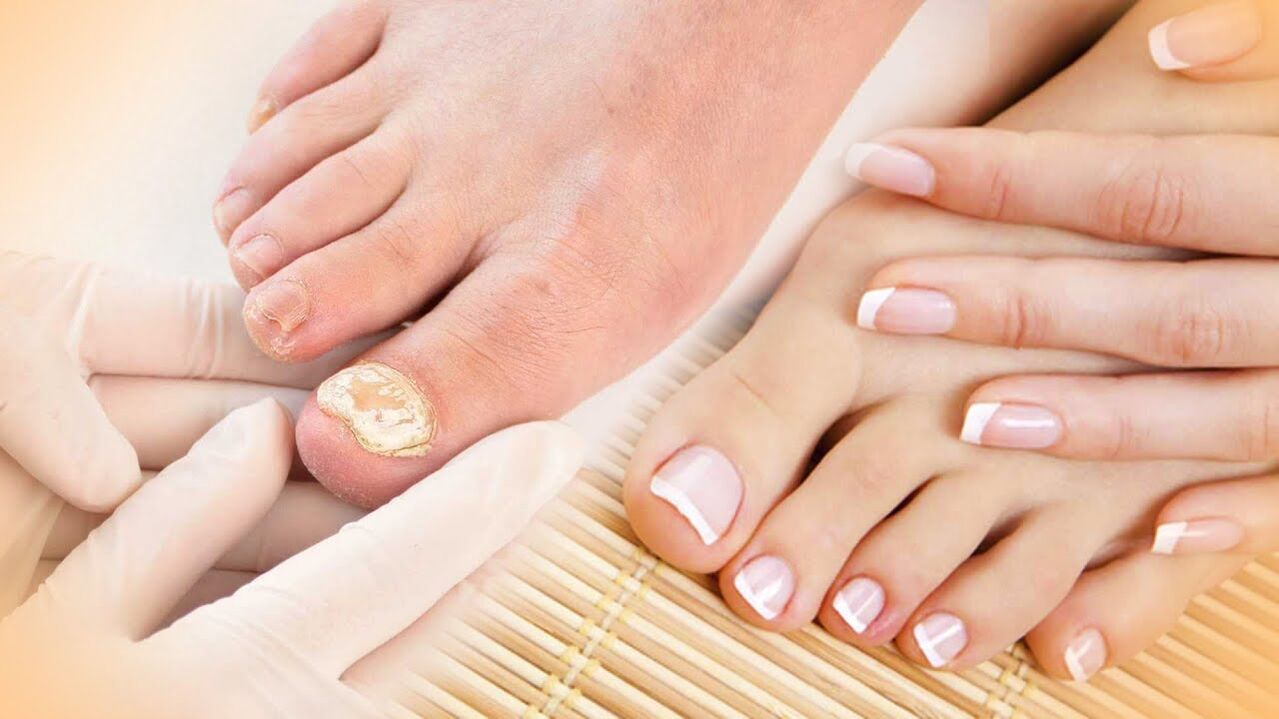 Fungus nail