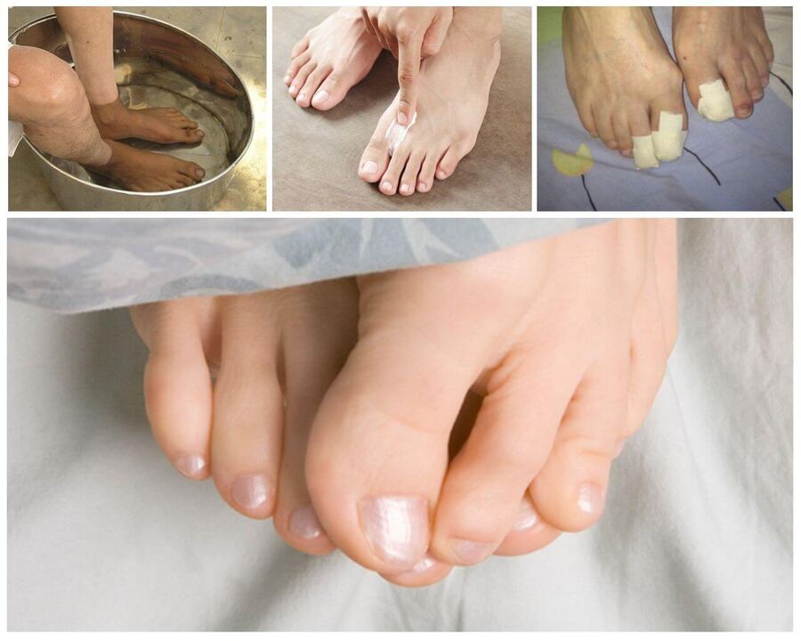 Fungus treatment