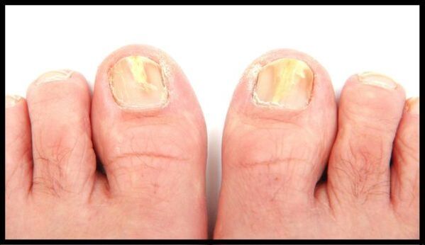 Fungus nail