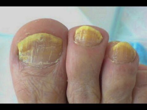 Fungus treatment
