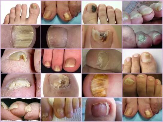 Onyhmicosis of various locals on nails