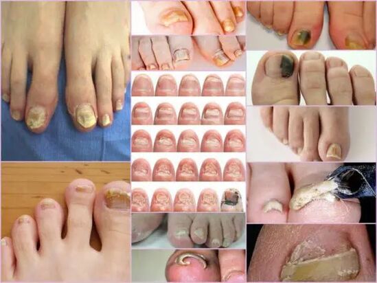 Sorts of ofychomicosis