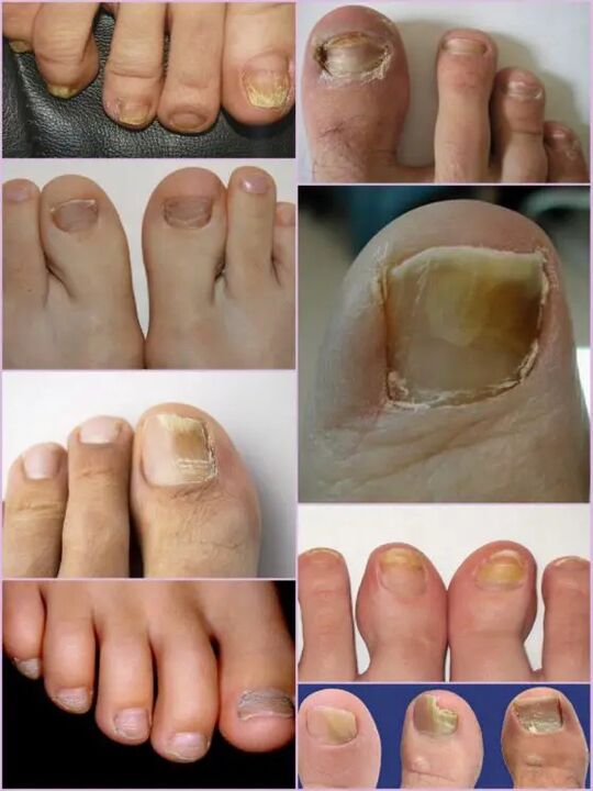 Varieties Fungus Nail