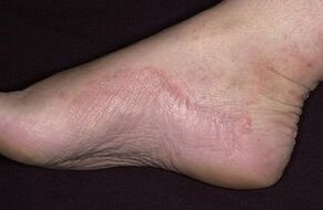 Fungal foot damage