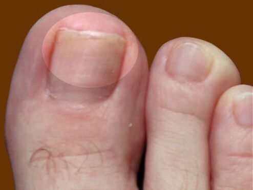 Fungi lesion