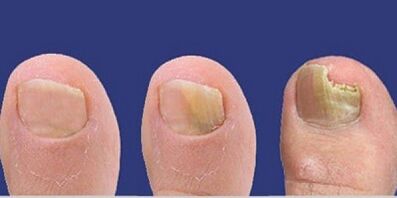 Phases of the fungus of nail